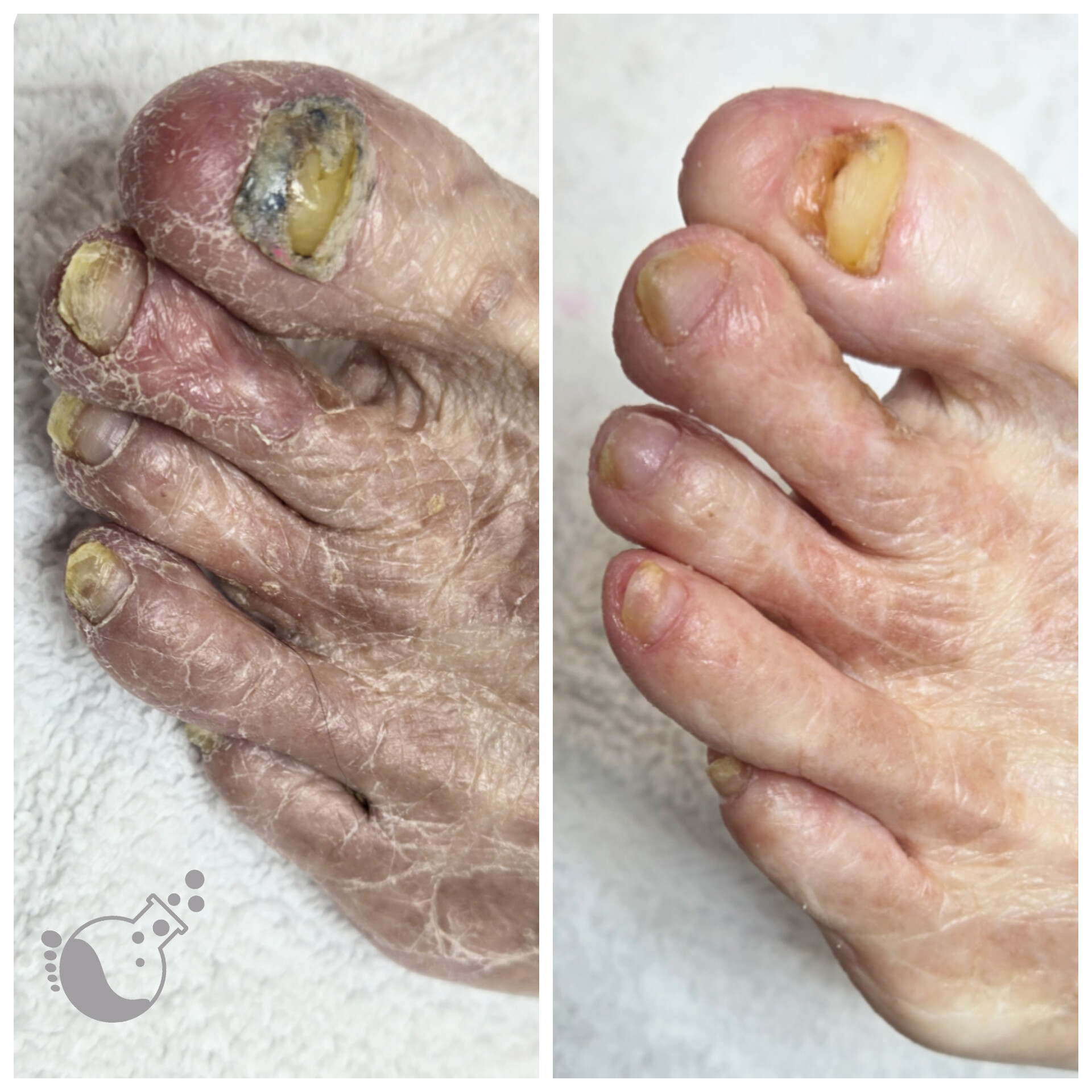 Comparison of a foot with thickened, discolored toenails and dry skin on the left, and a healthier foot on the right.
