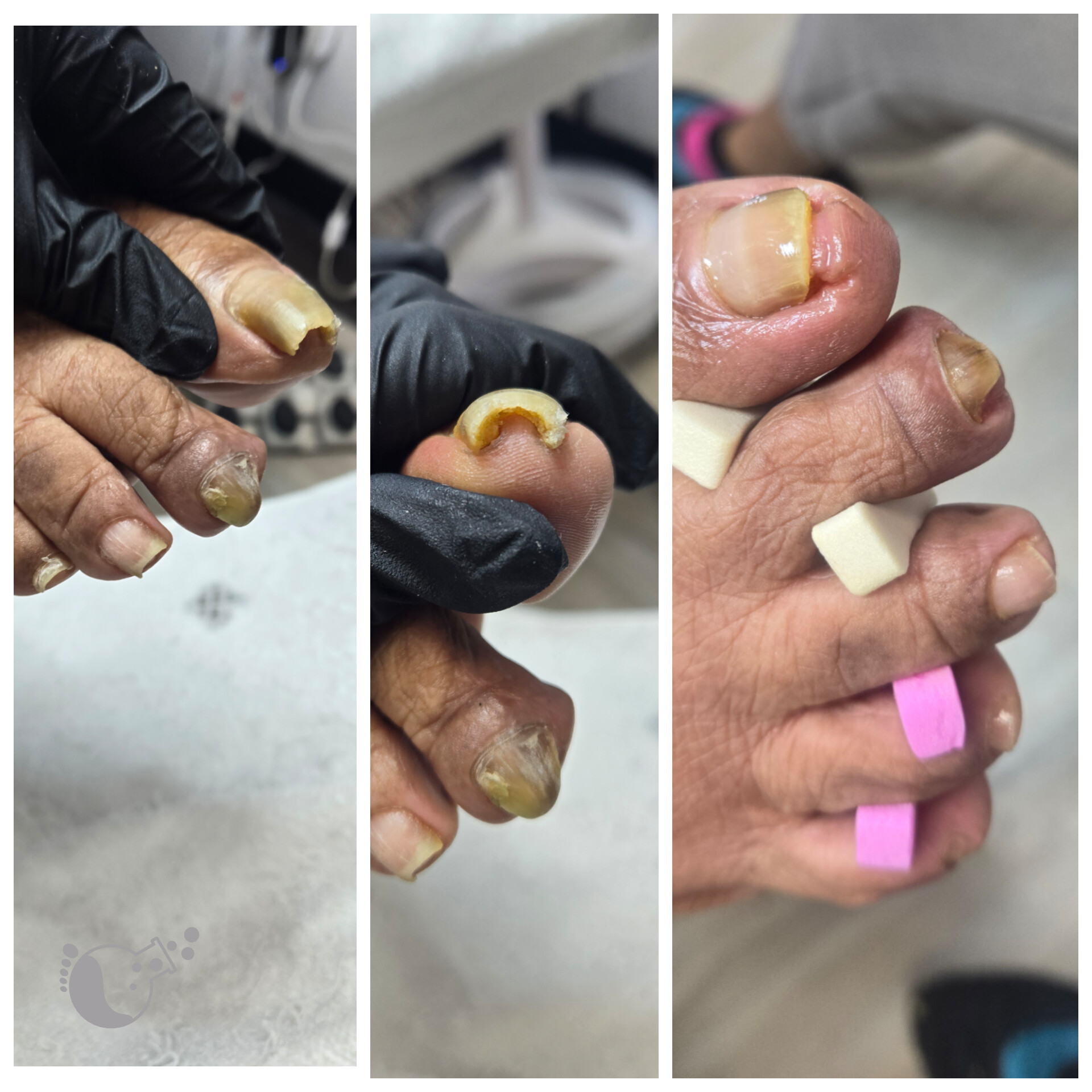 Close-up of a person's toes with damaged nails, some with bandages, in a medical setting. Three images show different angles.