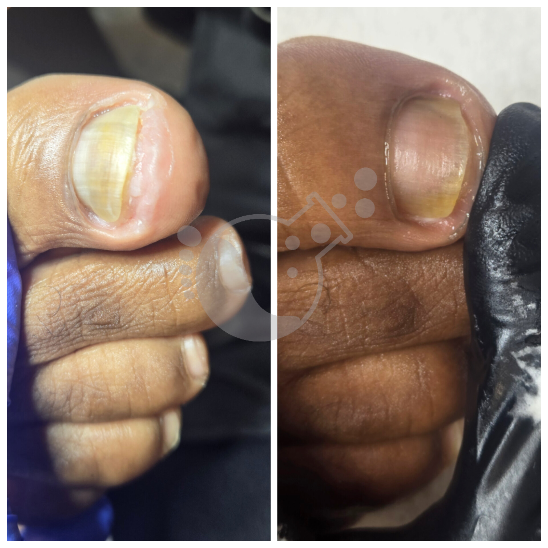 Close-up of a thumb with a yellowish nail, showing before and after nail treatment, with a black glove visible.