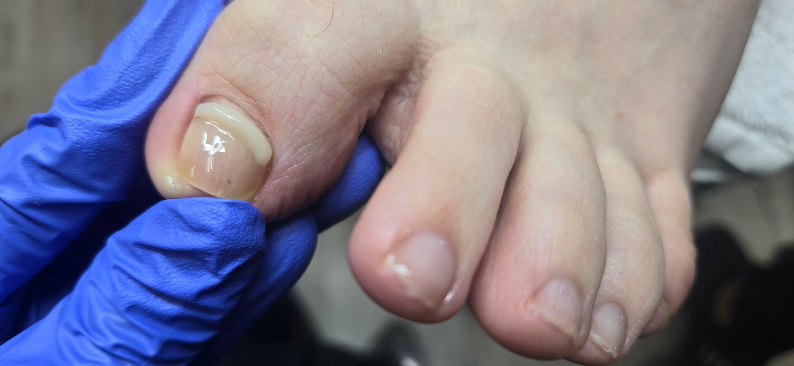 Close-up of a foot with a healthcare worker wearing blue gloves holding a toenail.